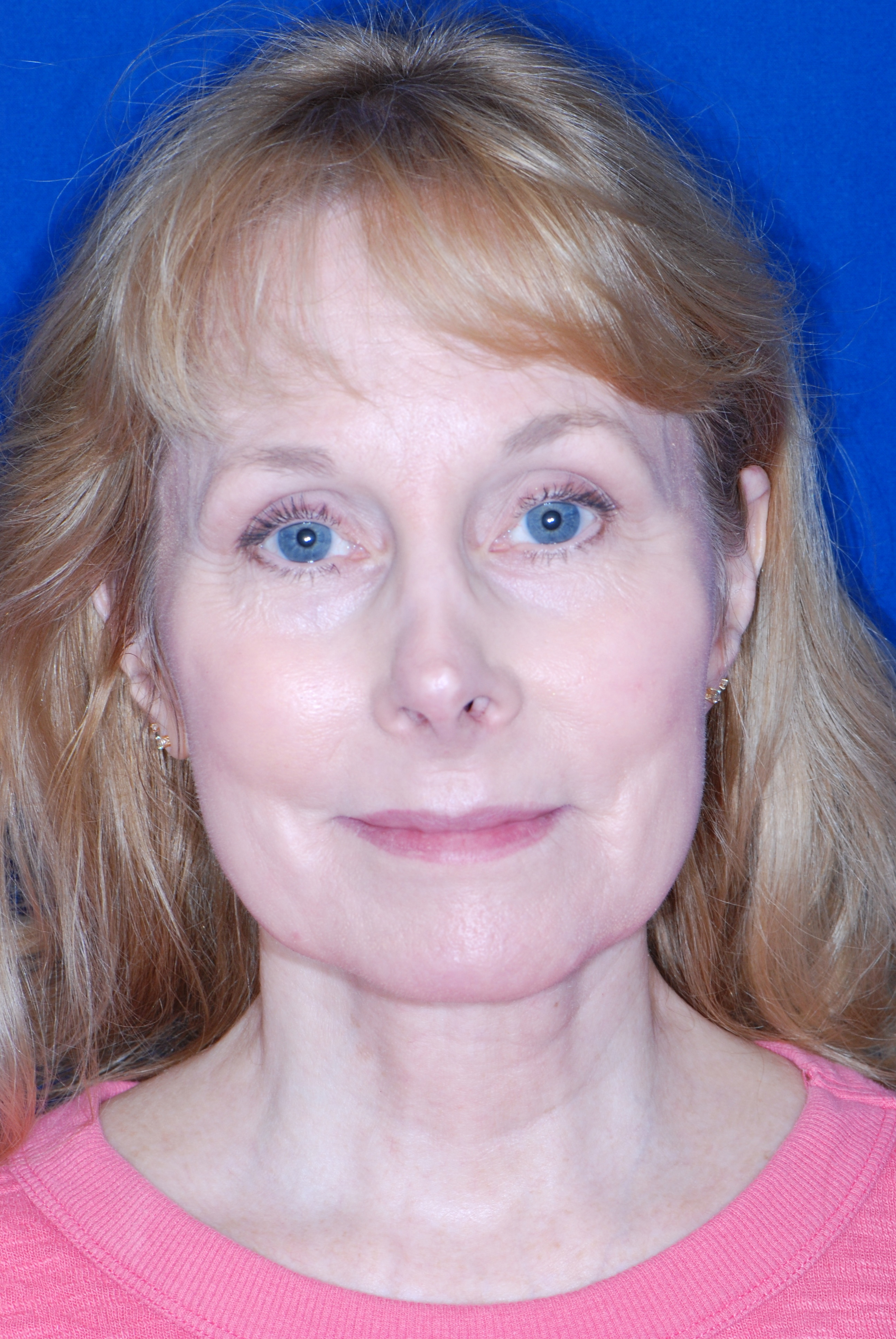 Neck Lift & Laser Resurfacing patient result