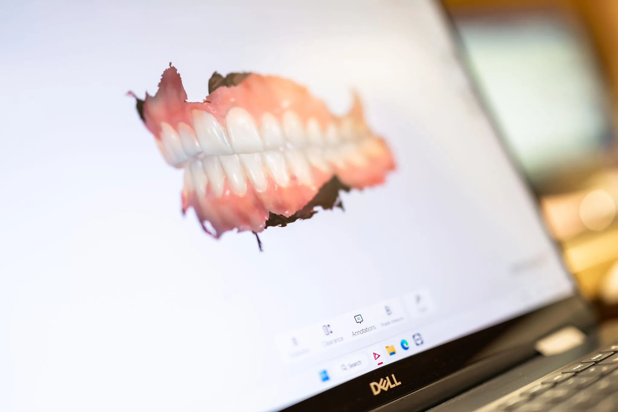 Teeth In A Day | Lake Norman Oral & Facial Surgery, Huntersville, NC