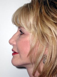 Multiple Cosmetic Procedures patient result