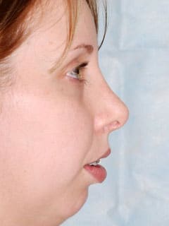 Rhinoplasty patient result